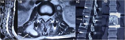 Avulsion fracture of the anterior superior iliac crest following autograft for anterior lumbar fusion: case report and literature review